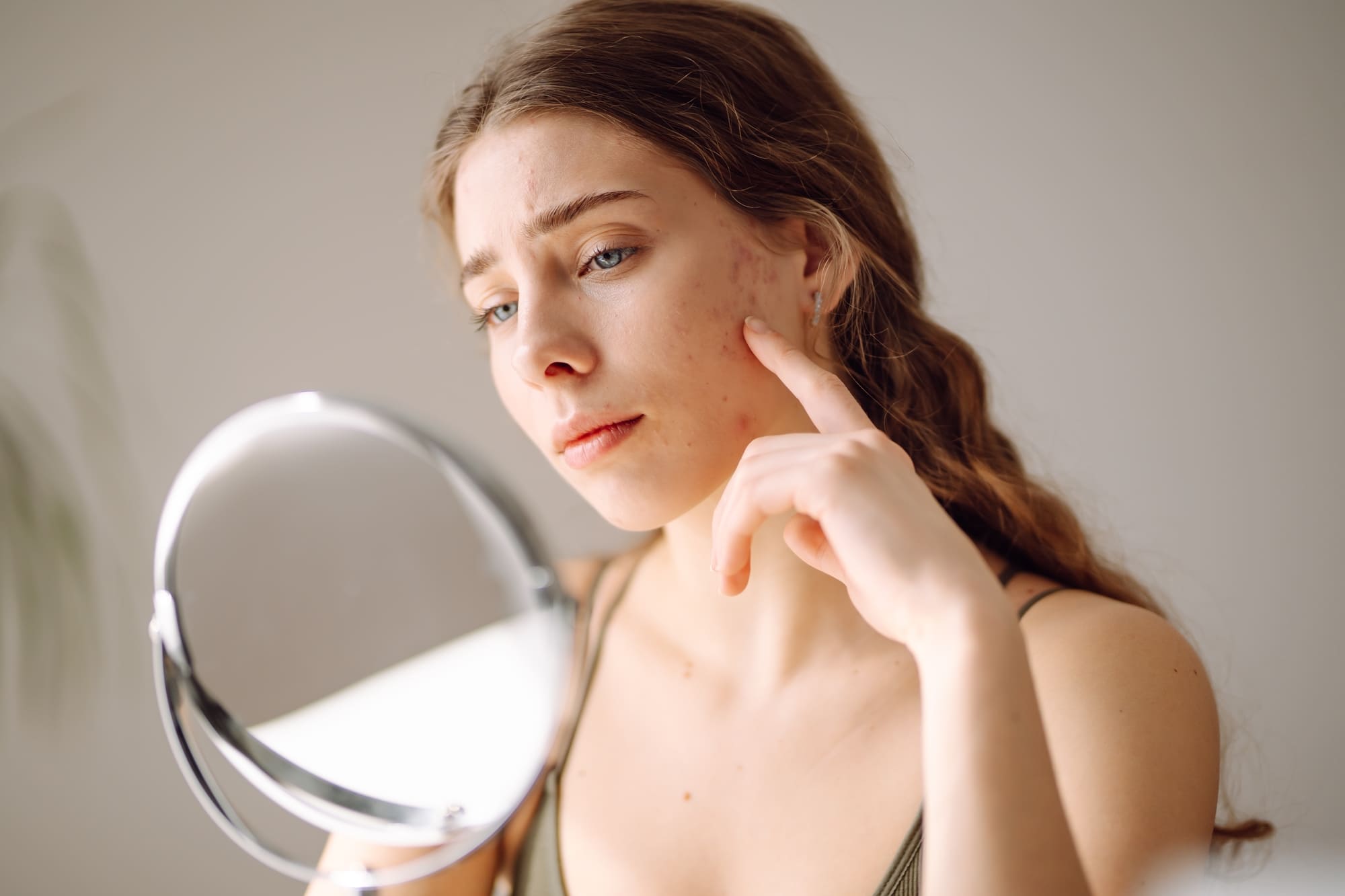 Cómo identificar los diferentes tipos de acne